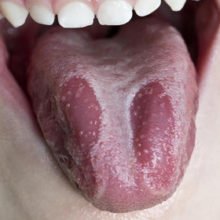 Глоссит языка — лечение народными средствами